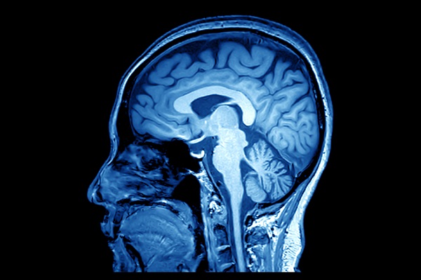 Scan of the brain